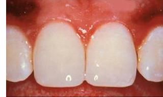 After Complete Smile Makeover