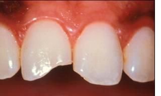 Before Complete Smile Makeover