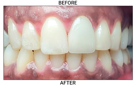 After Porcelain Crowns Restoration
