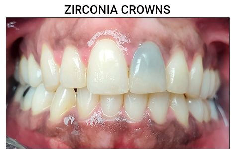 Before Porcelain Crowns Restoration