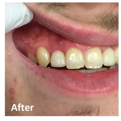 After Single Dental Implant