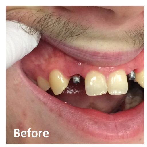 Before Single Dental Implant