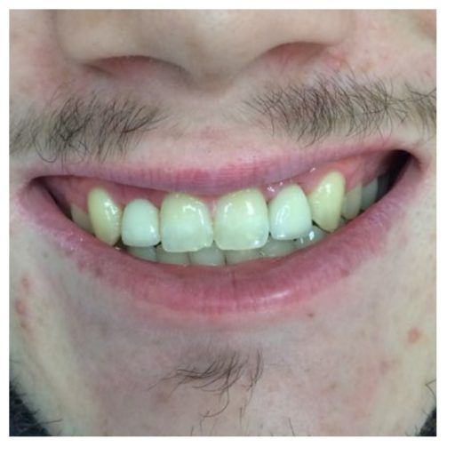 After Multiple Dental Implants