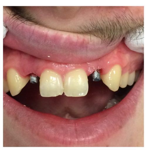 Before Multiple Dental Implants