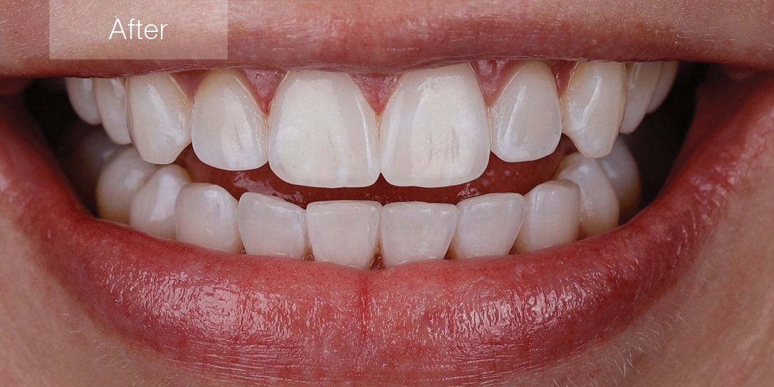 After Invisalign Treatment