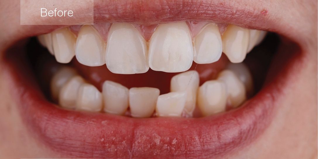 Before Invisalign Treatment