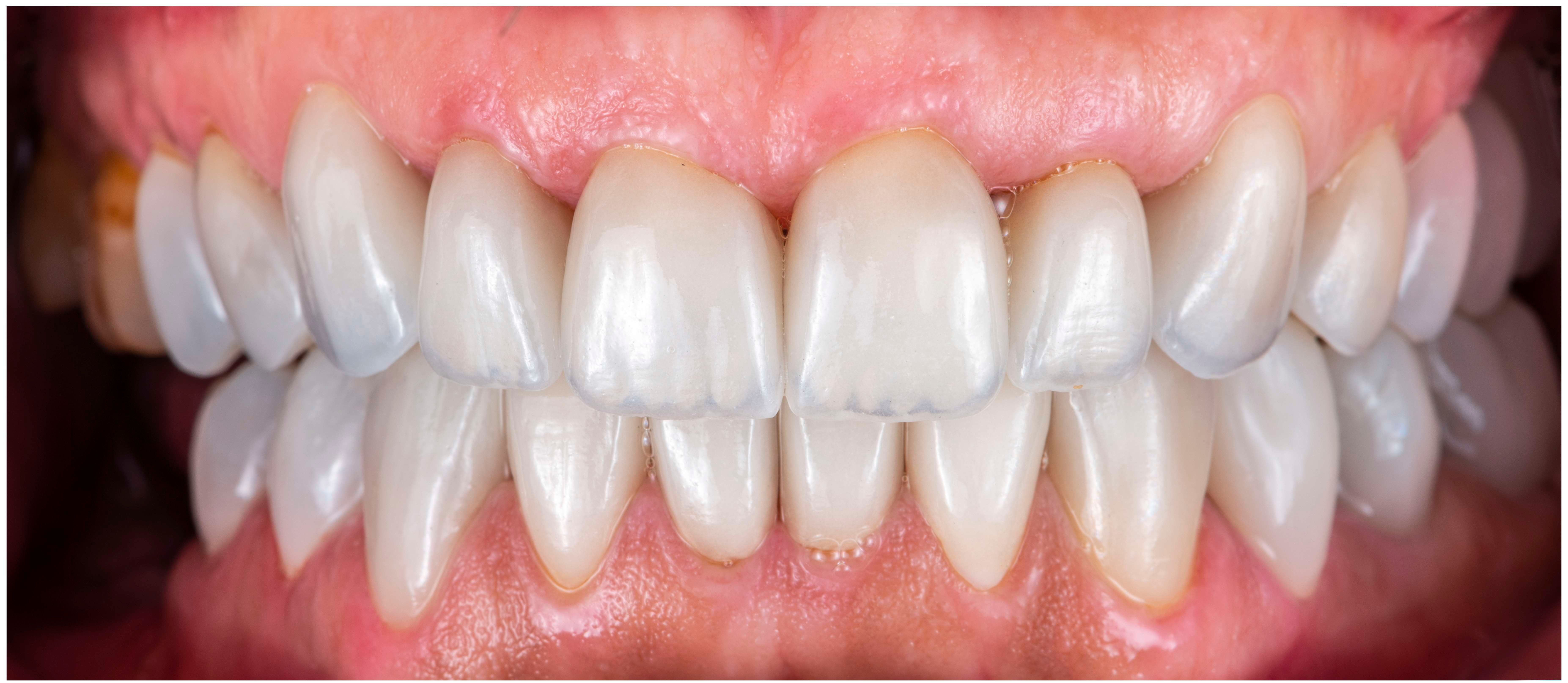 After Porcelain Veneers - Full Smile