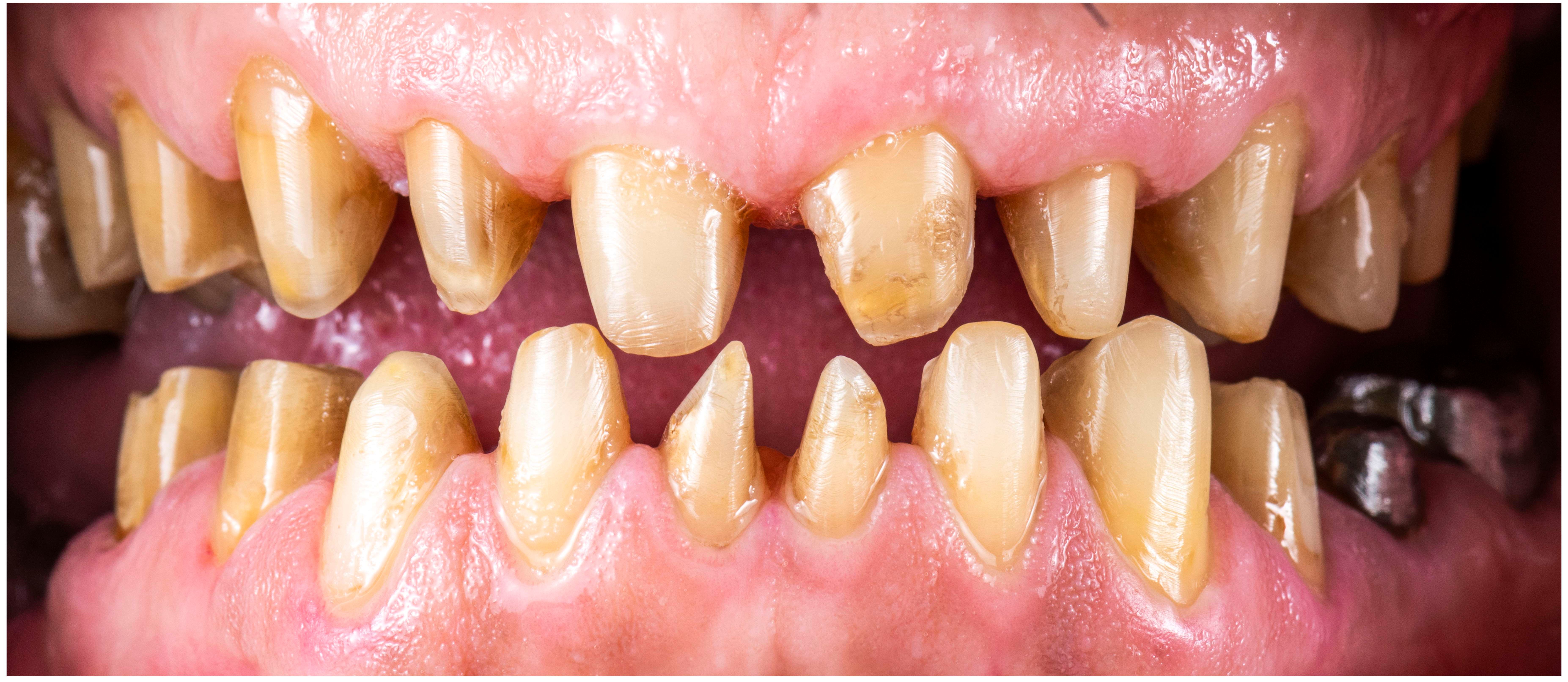 Before Porcelain Veneers - Full Smile