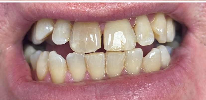 After Professional Teeth Whitening