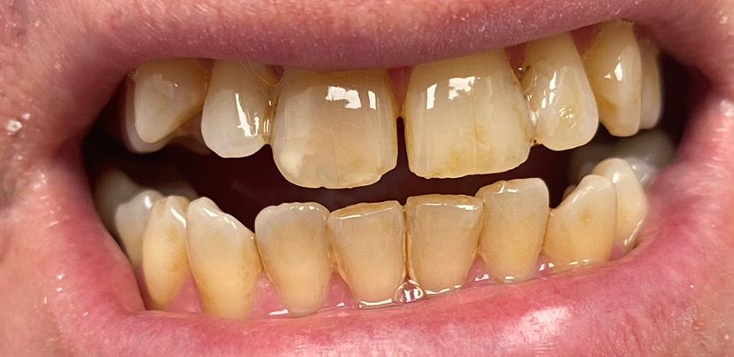 Before Professional Teeth Whitening